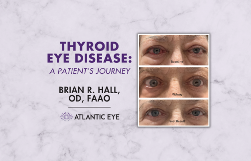 Thyroid eyes showing red before and after treatment clear result