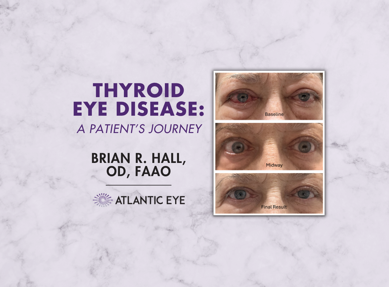 Thyroid eyes showing red before and after treatment clear result